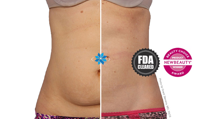 coolsculpting near me now